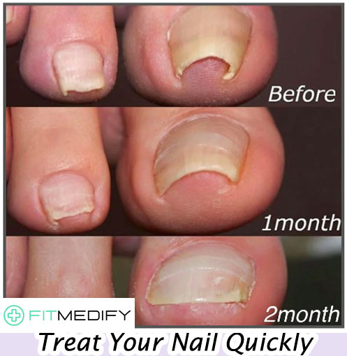 Fitmedify Toenail Reviews